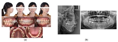 牙齒丟哪裡|牙齒掉了丟屋頂？ – 黃郁芩醫師 Orthodontics